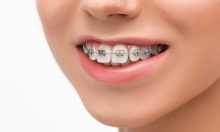 Braces in Brooking