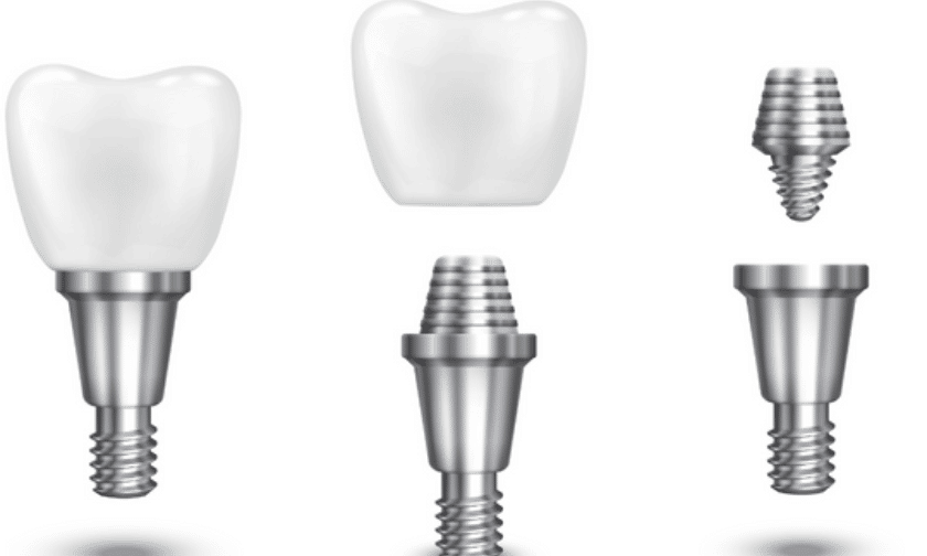 Implant Dentist Brookings