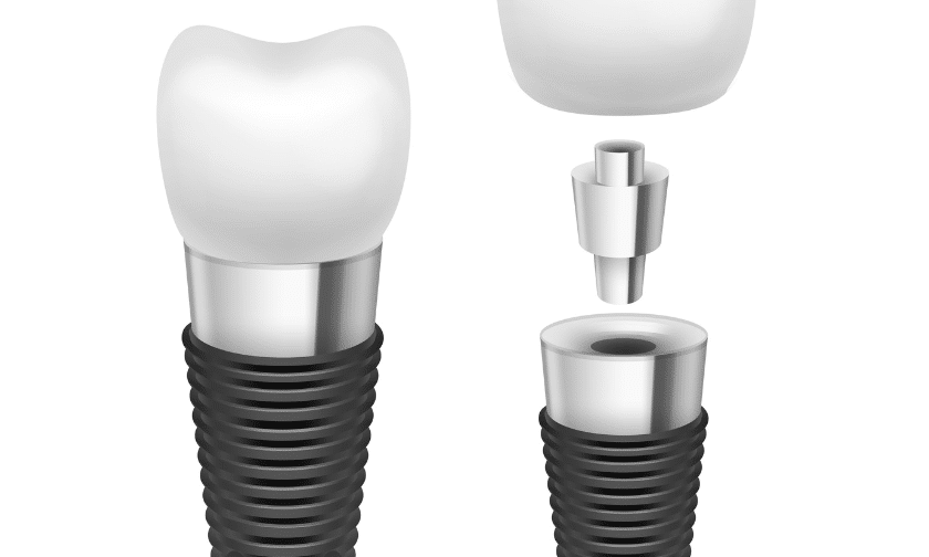 Dental Implants Brookings