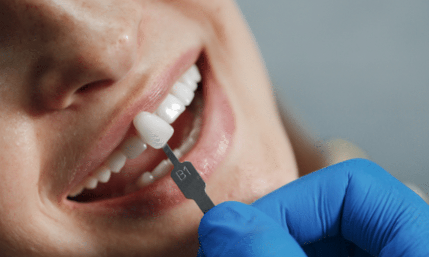 Porcelain Veneers Brookings