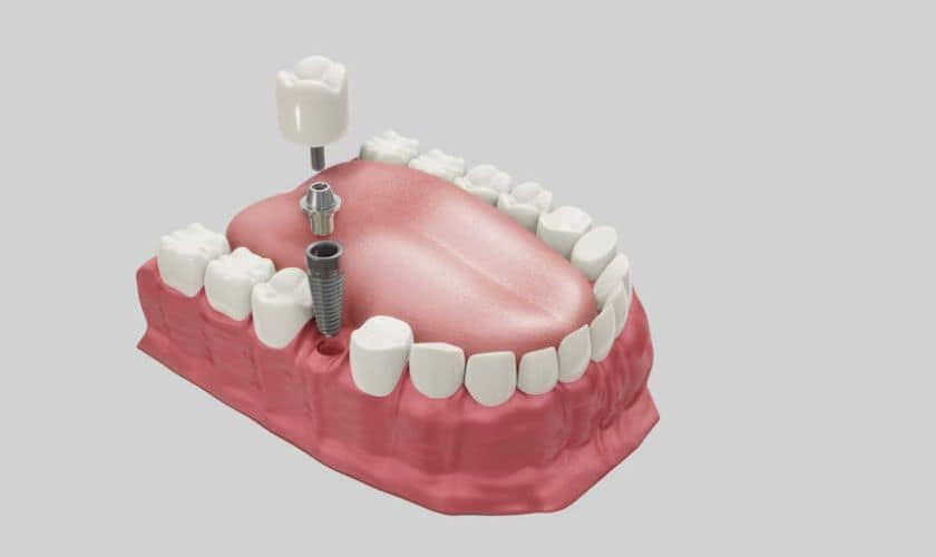 Dental Implants in Brookings, OR
