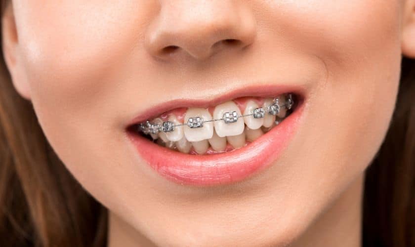 Braces in Brookings, OR