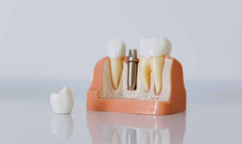 dental implants feel natural